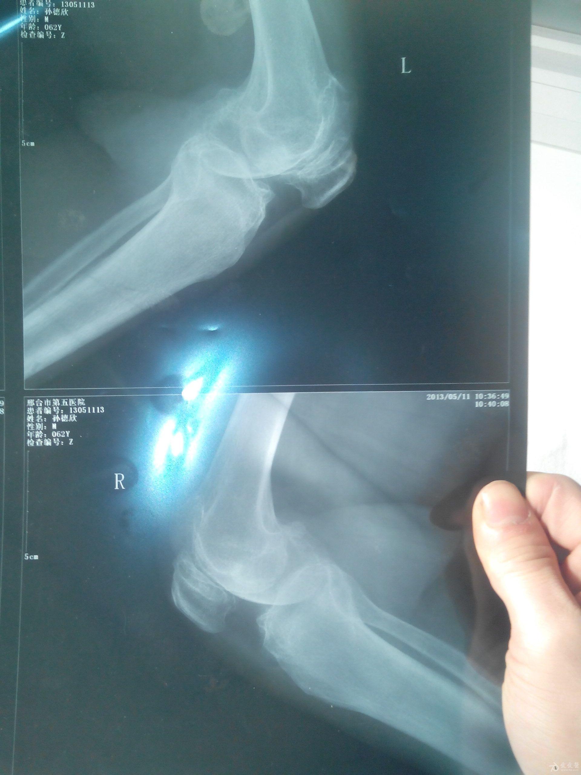 膝盖CT正常图片图片