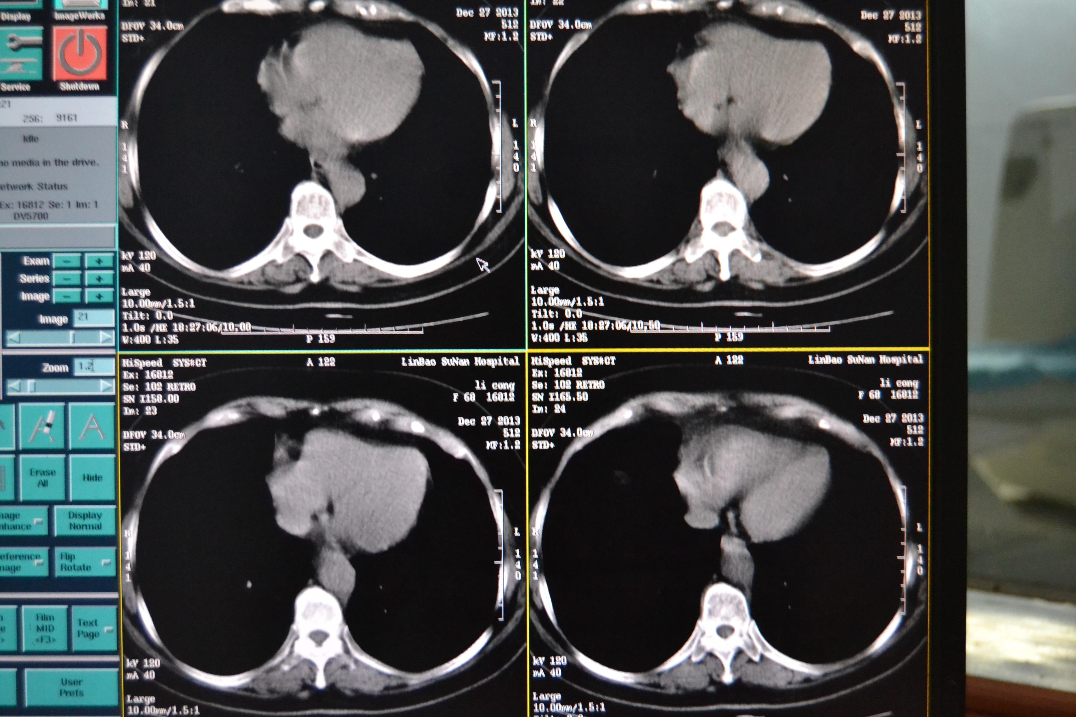 胸部增强ct www.iiyi.com
