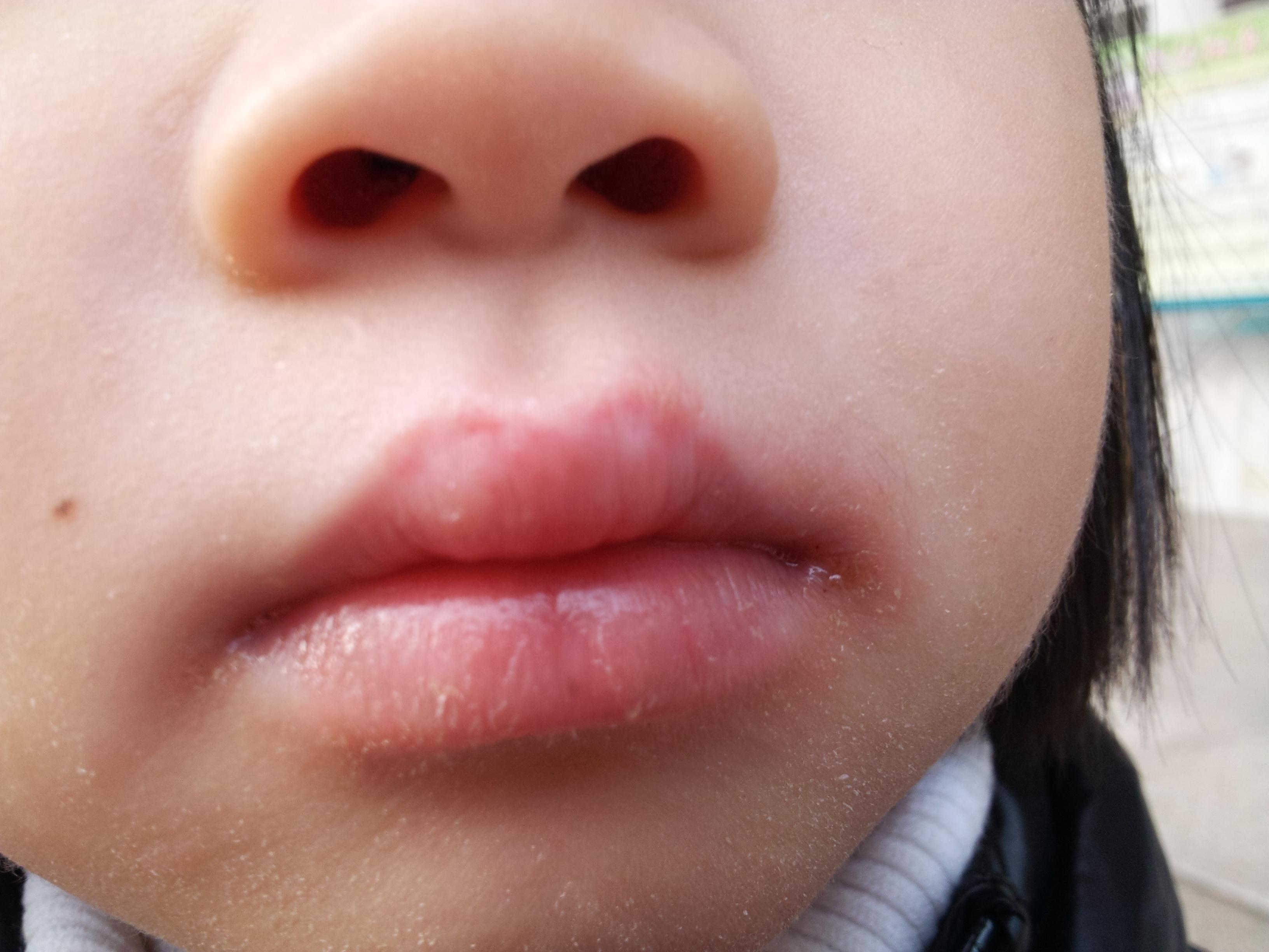 儿童口周皮炎图片症状图片