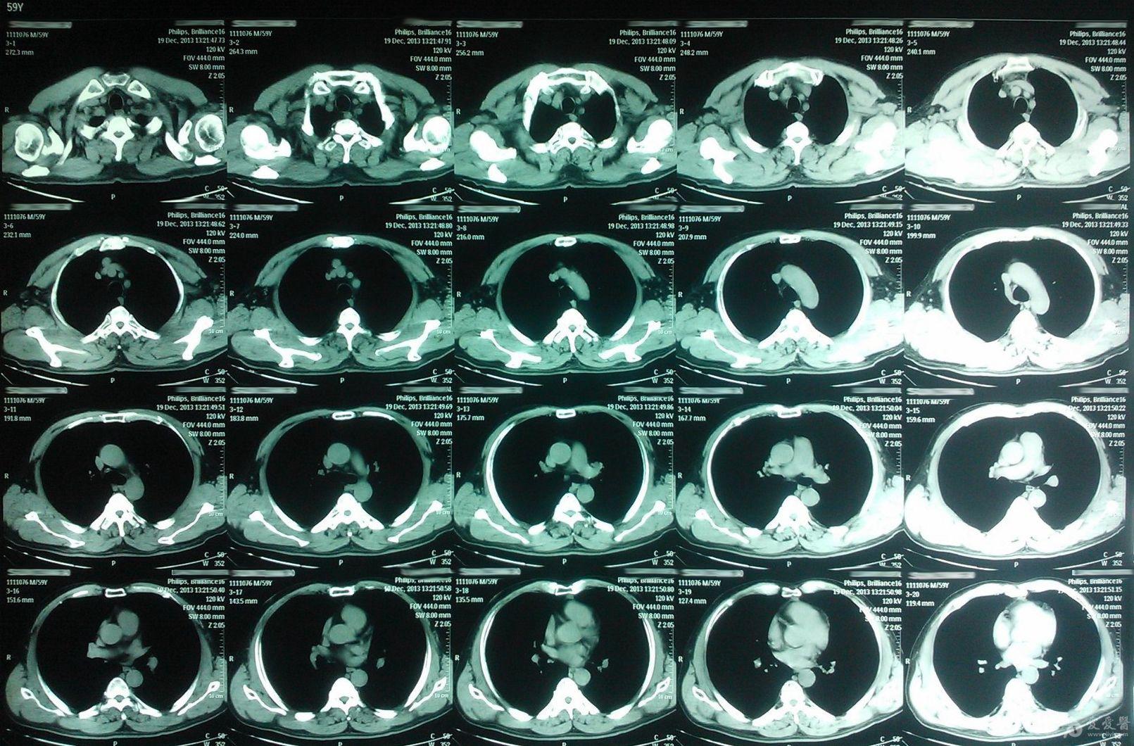胸痛,纵膈淋巴结肿大