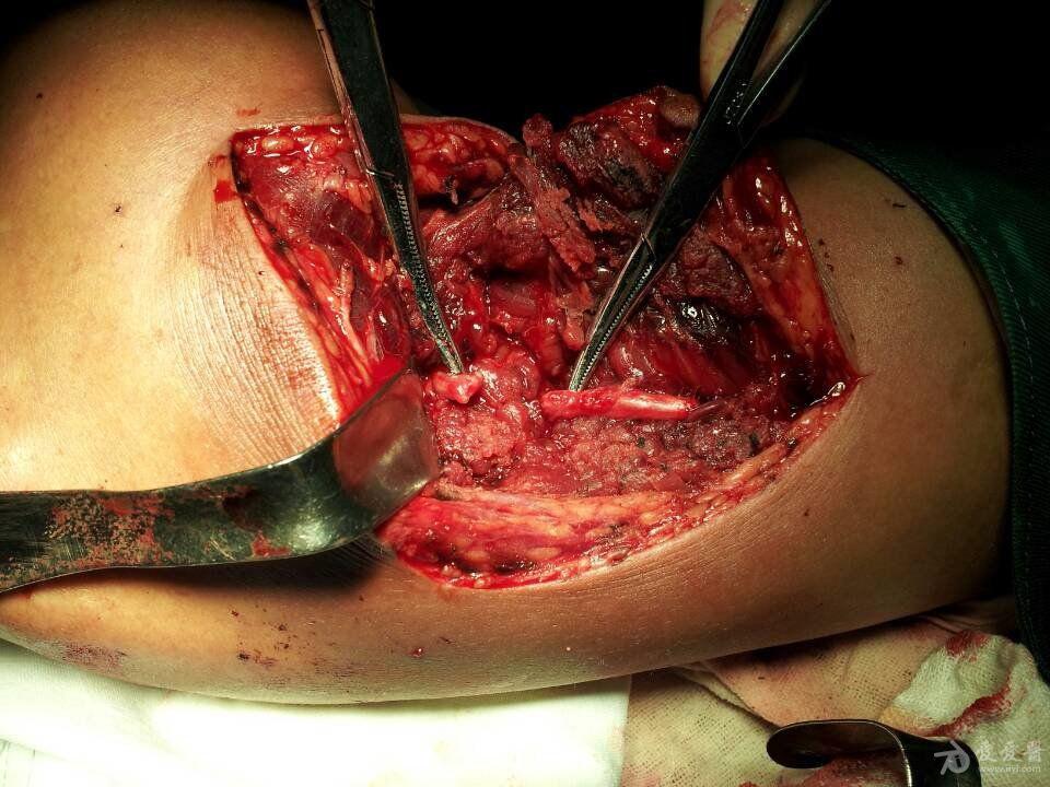 左侧桡神经离断伤