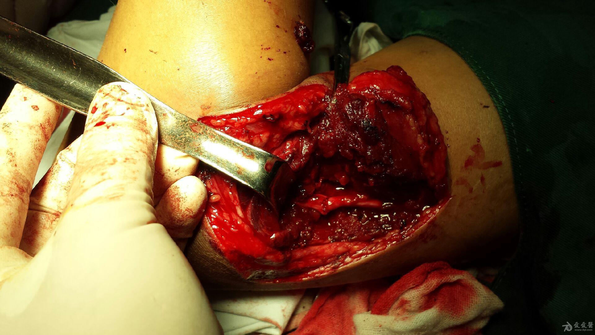 左侧桡神经离断伤