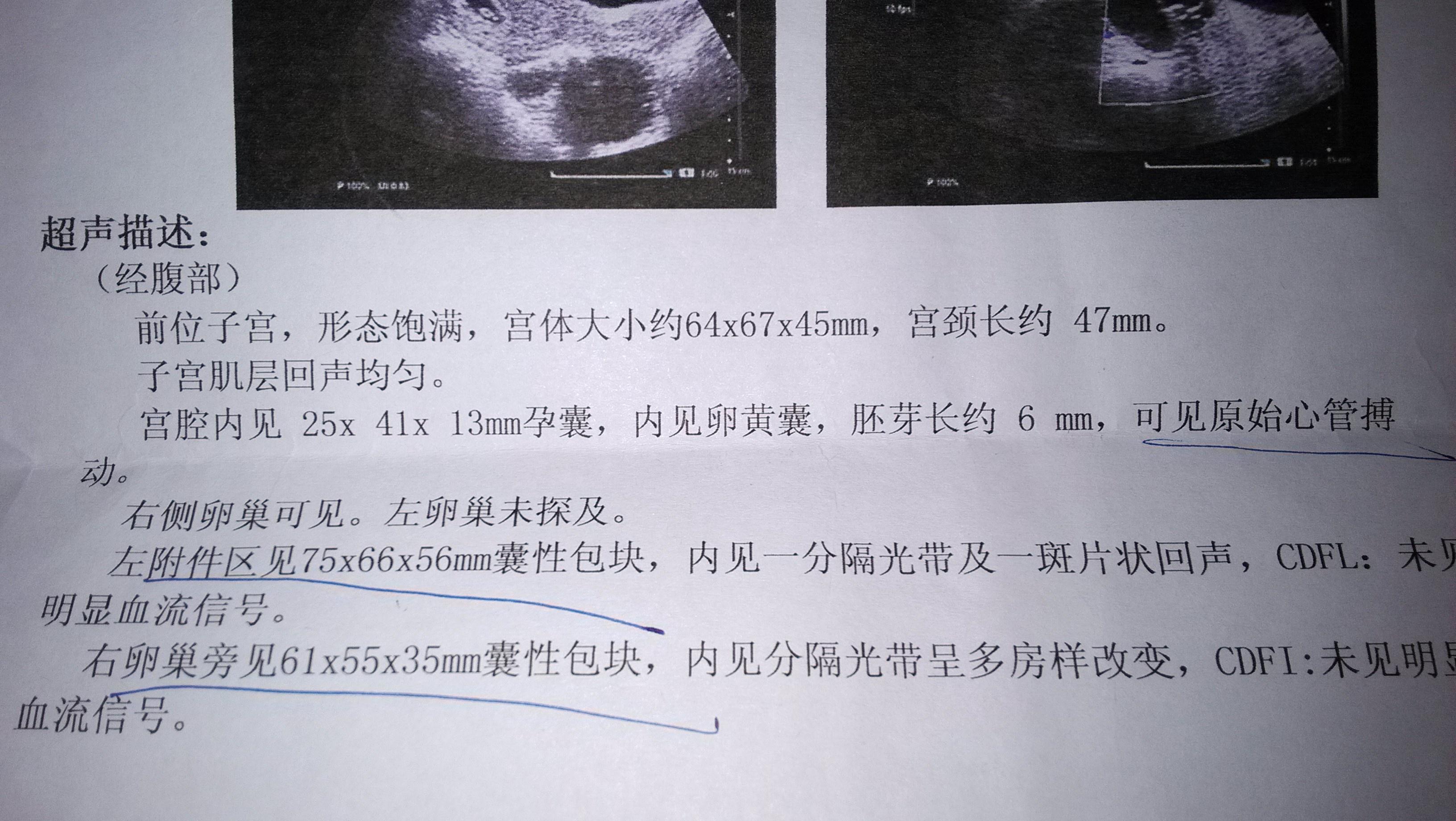 懷孕合併雙側囊腫