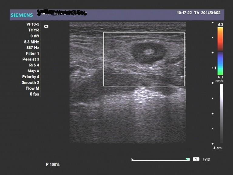 请教下颌下腺这个是淋巴结肿大吗