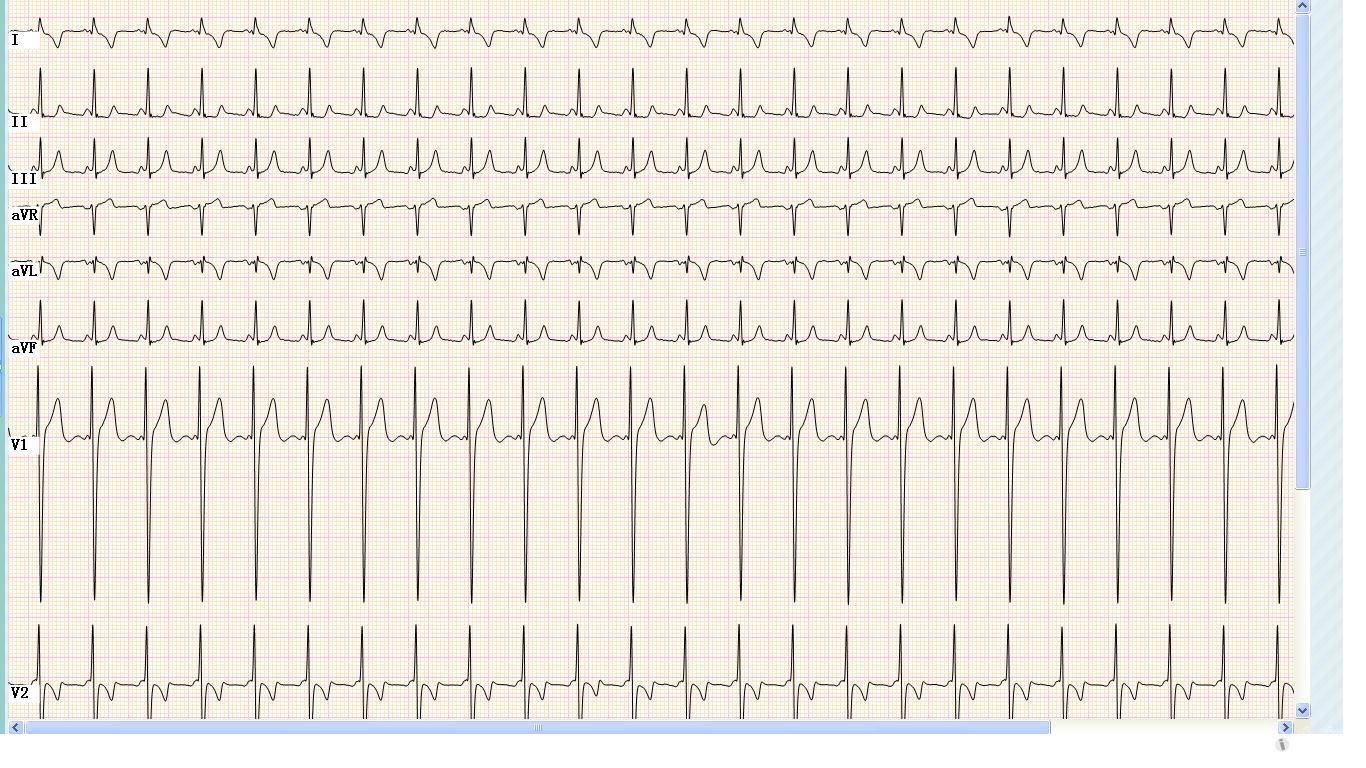 请山羊老师和版主看看,右位心的心电图-是右旋心吗