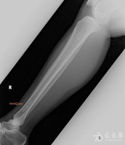 右脚胫骨肿瘤诊断与鉴别诊断附x线影像
