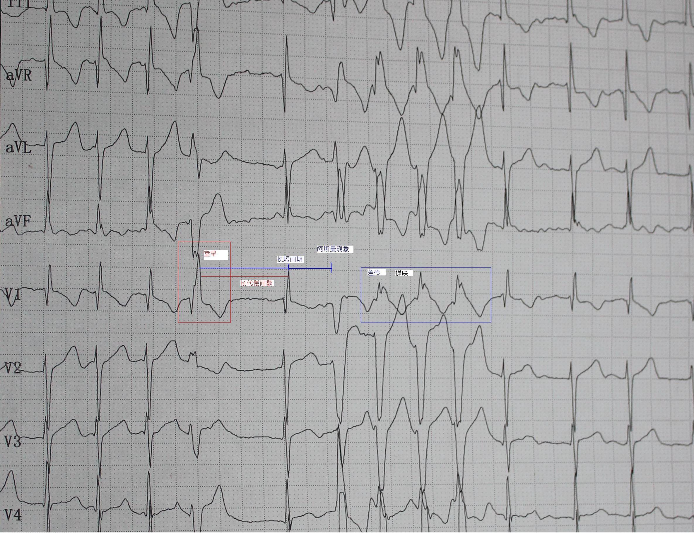 1,快速心房纤颤伴差传 2,室早 3,不完全性右束支传导阻滞 4,st-t