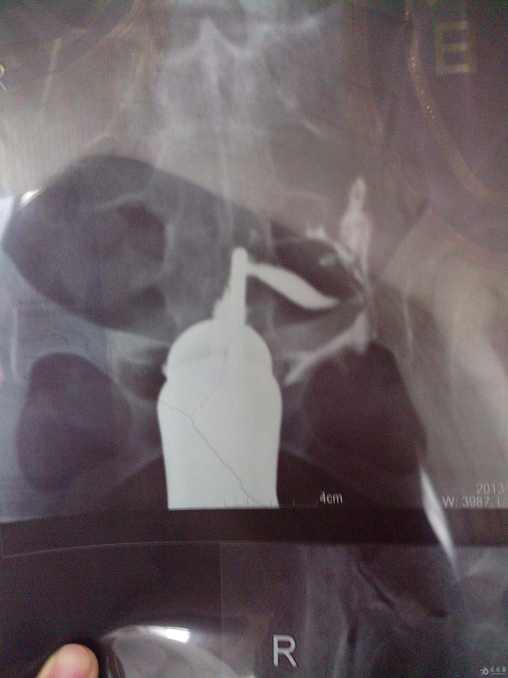 单角子宫彩超看不出来吗妇检查不出后倾位吗