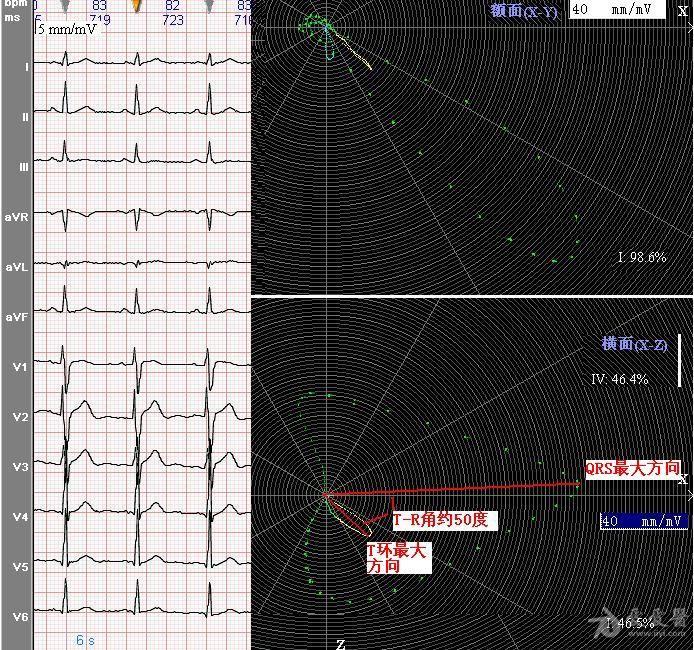 請教:t波振幅與r波遞增是否有關係 - 心電圖培訓版 - 愛愛醫醫學論壇