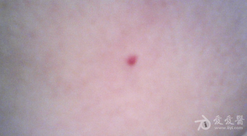 面部皮肤有一个小充血点