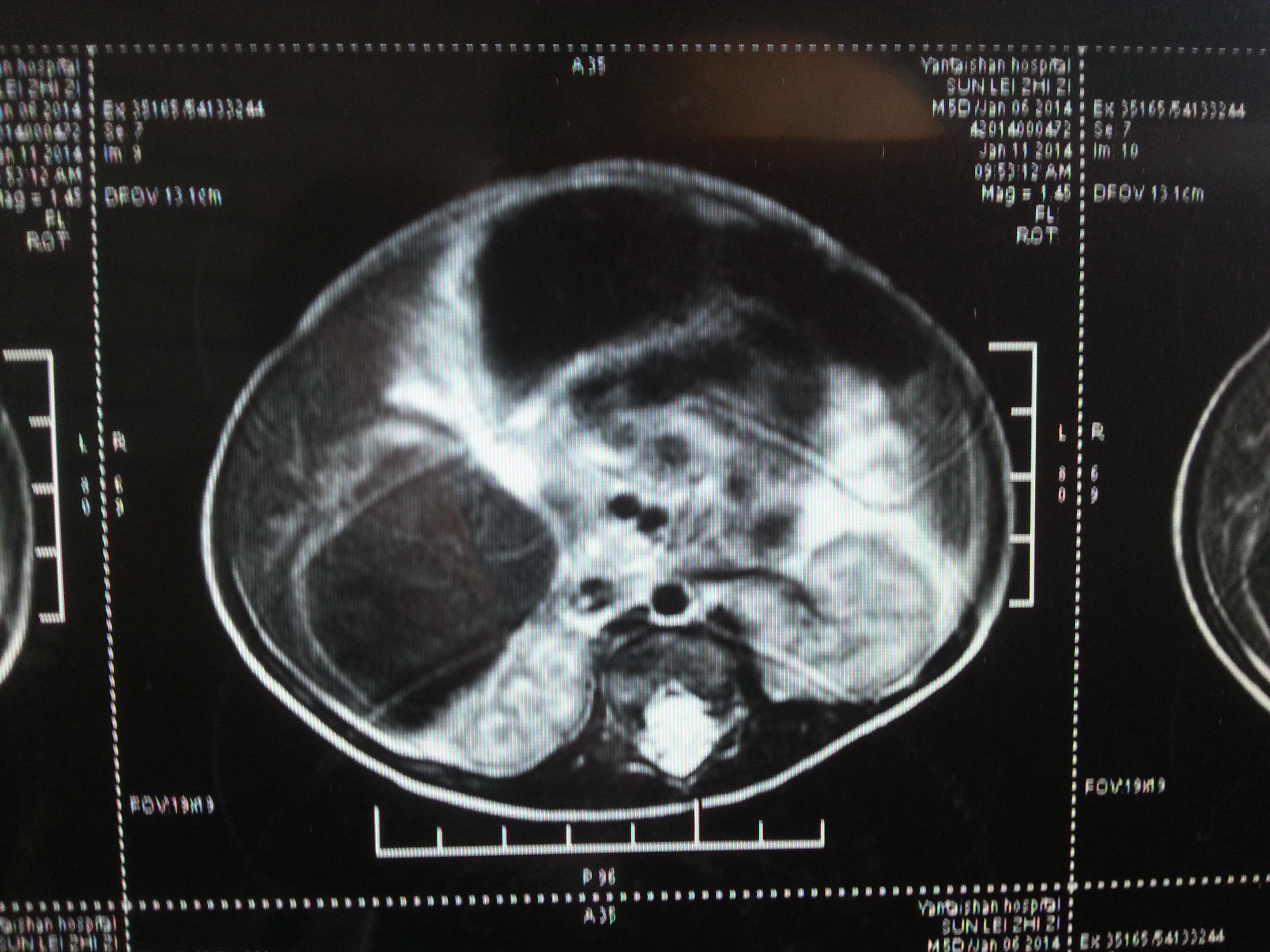 新生儿什么时候可以做胆囊检查 140113124482251ae0fe6281e8.jpg