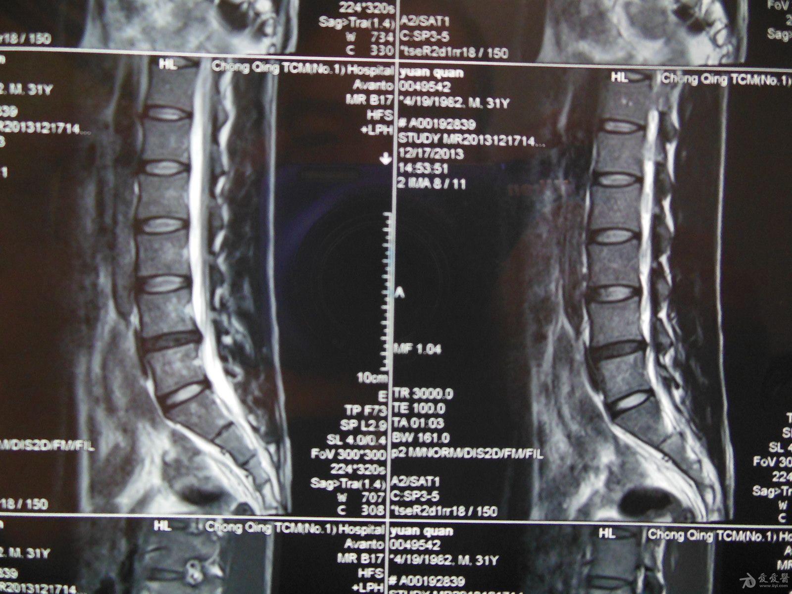 请放射科的老师看看这个腰椎核磁共振的片子