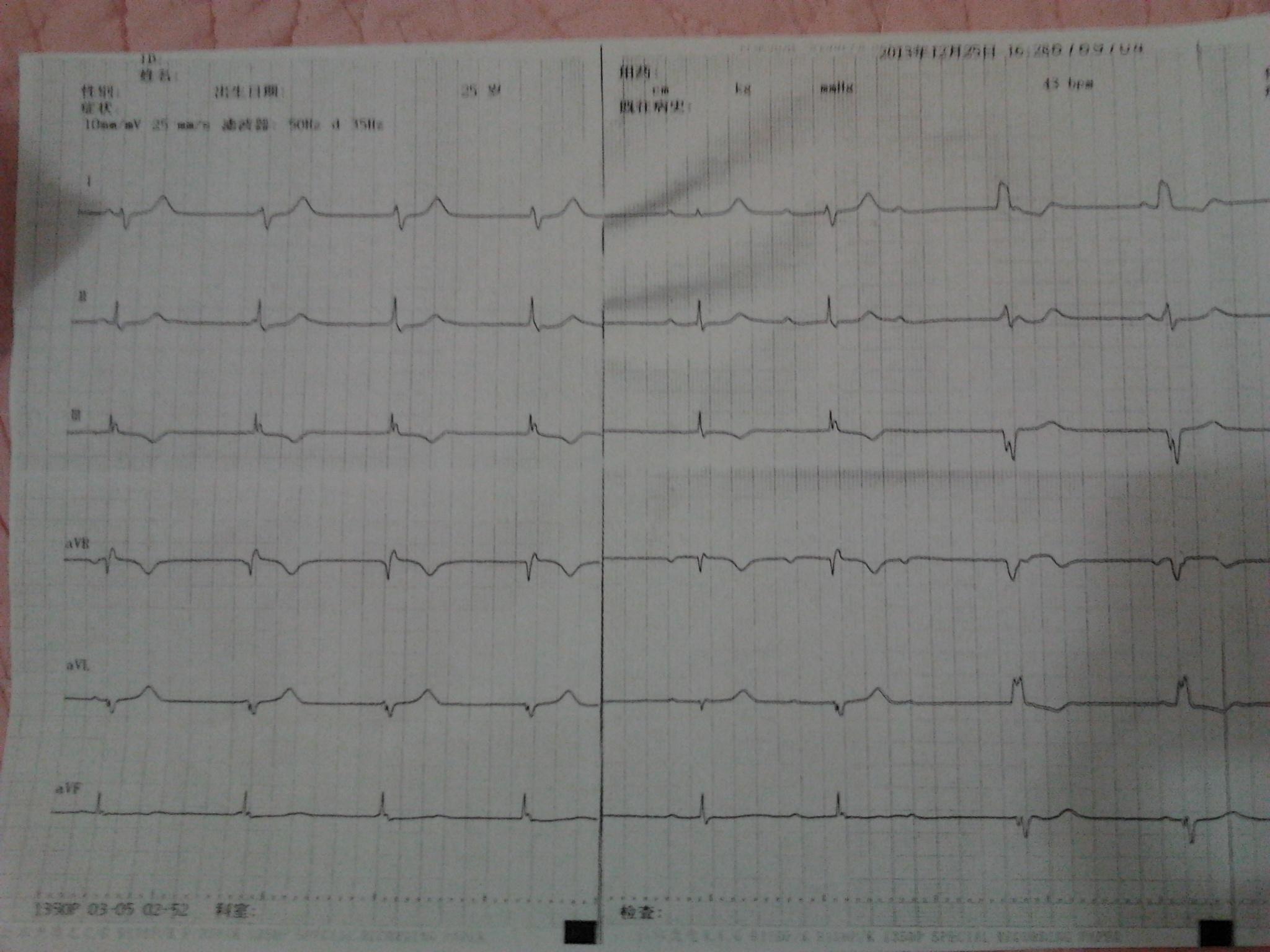 三度房室传导阻滞 - 心电图脑电图专业讨论版 - 爱爱医医学论坛