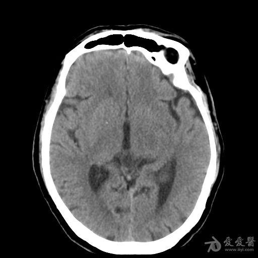 松果體囊腫一例提供討論