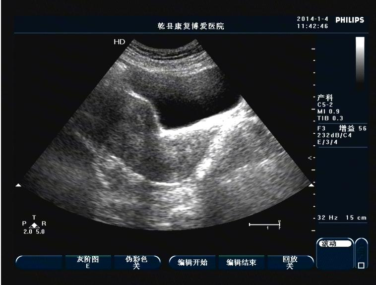 子宫内膜增生超声图片图片