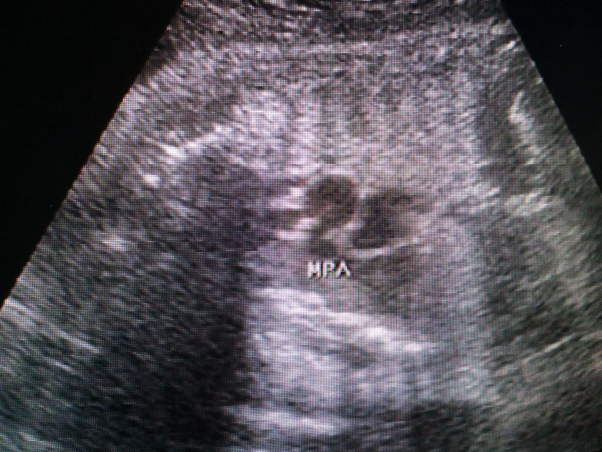 胎儿心脏图片