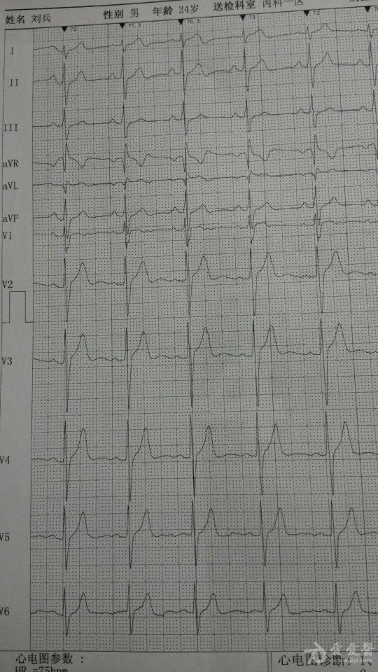 阿斯综合征心电图图片