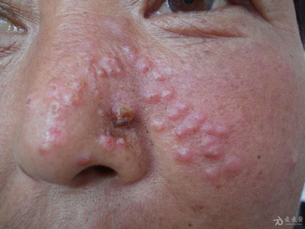 皮肤病孢子丝菌病5例