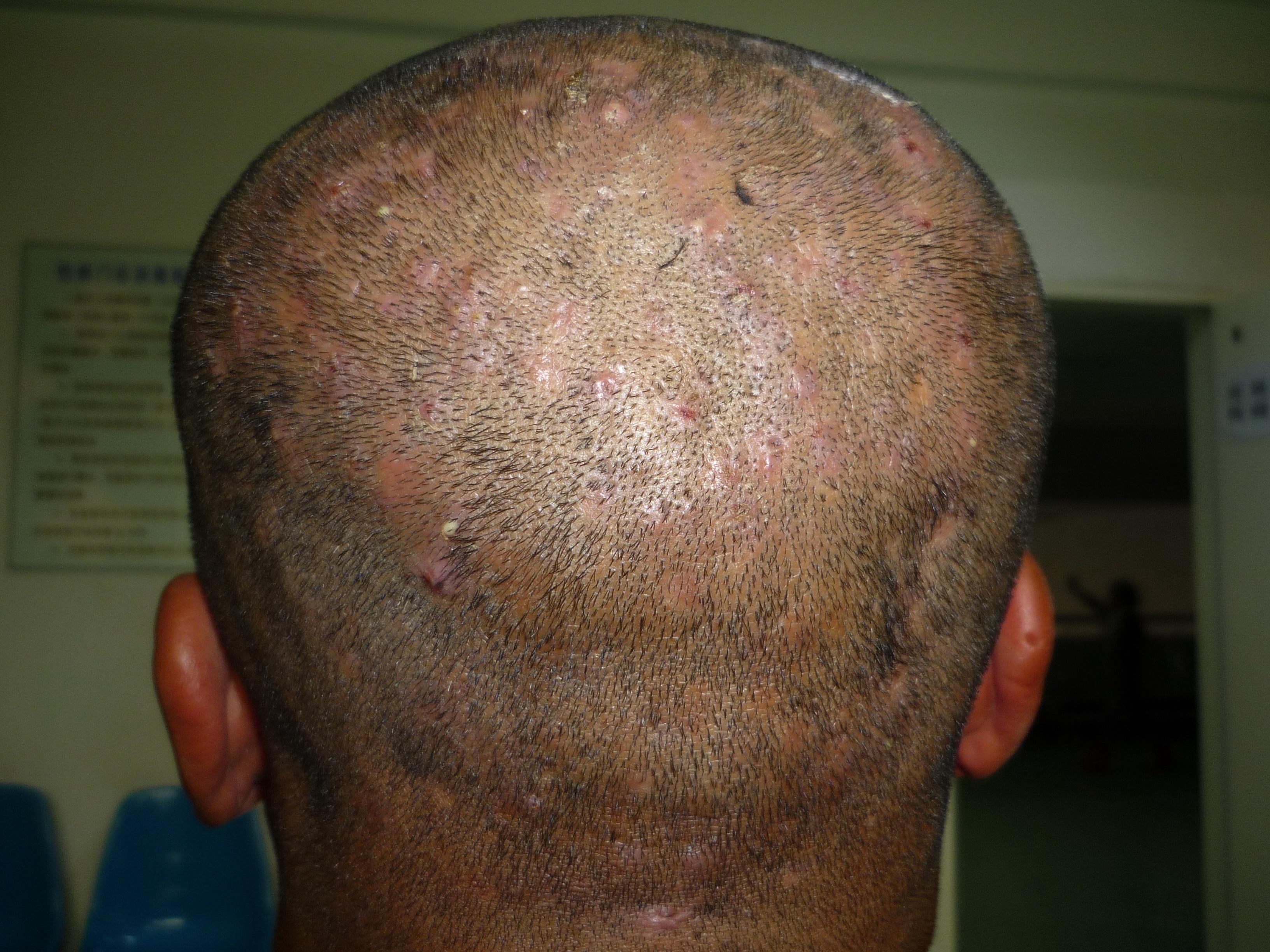 典型病例头部脓肿性穿掘性毛囊周围炎