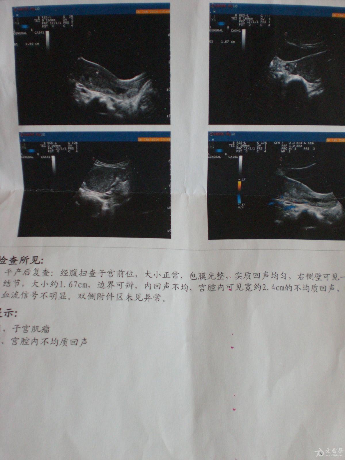 引產後宮腔組織殘留還是淤血