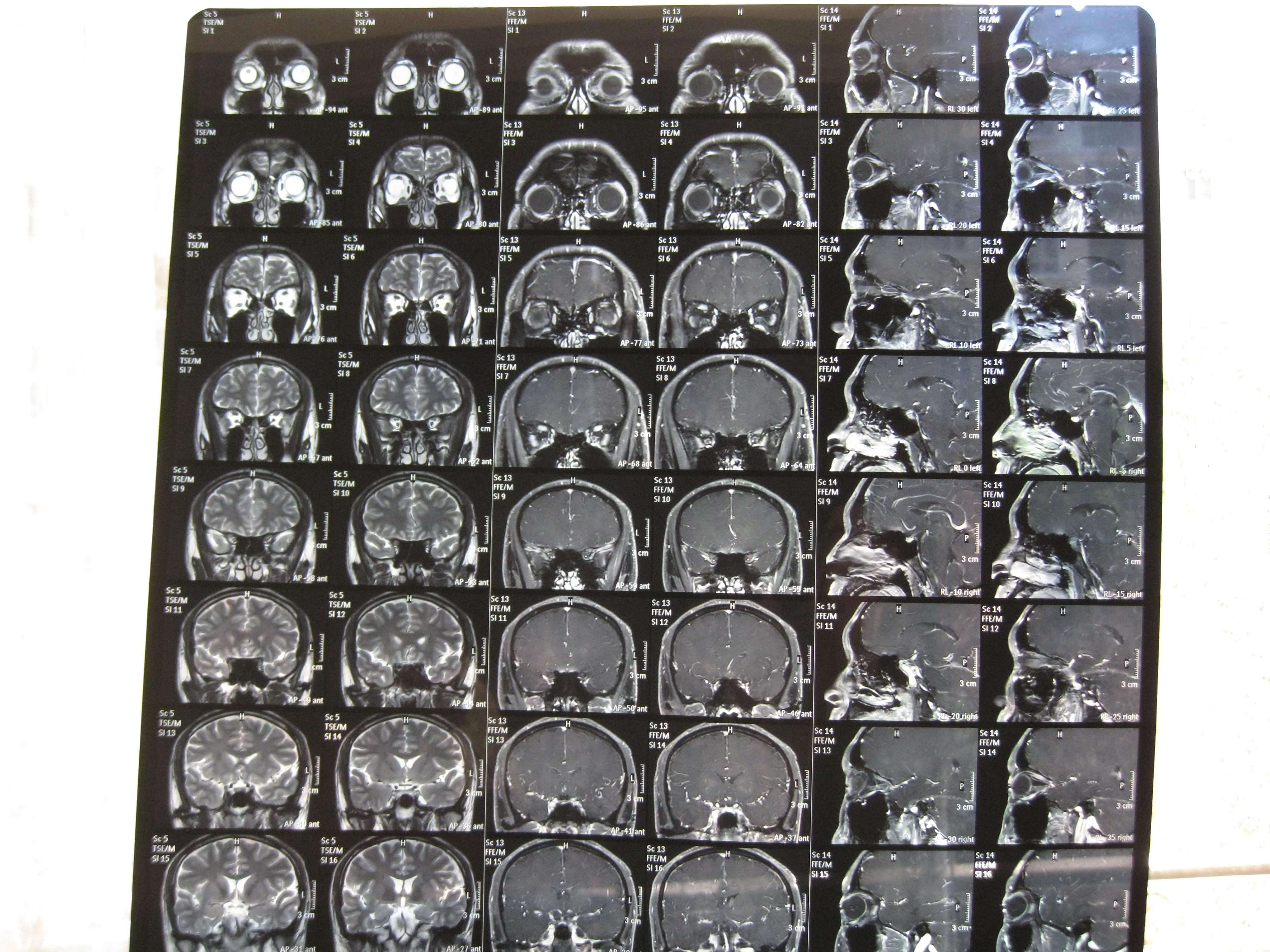 正常脑磁共振片子图片图片