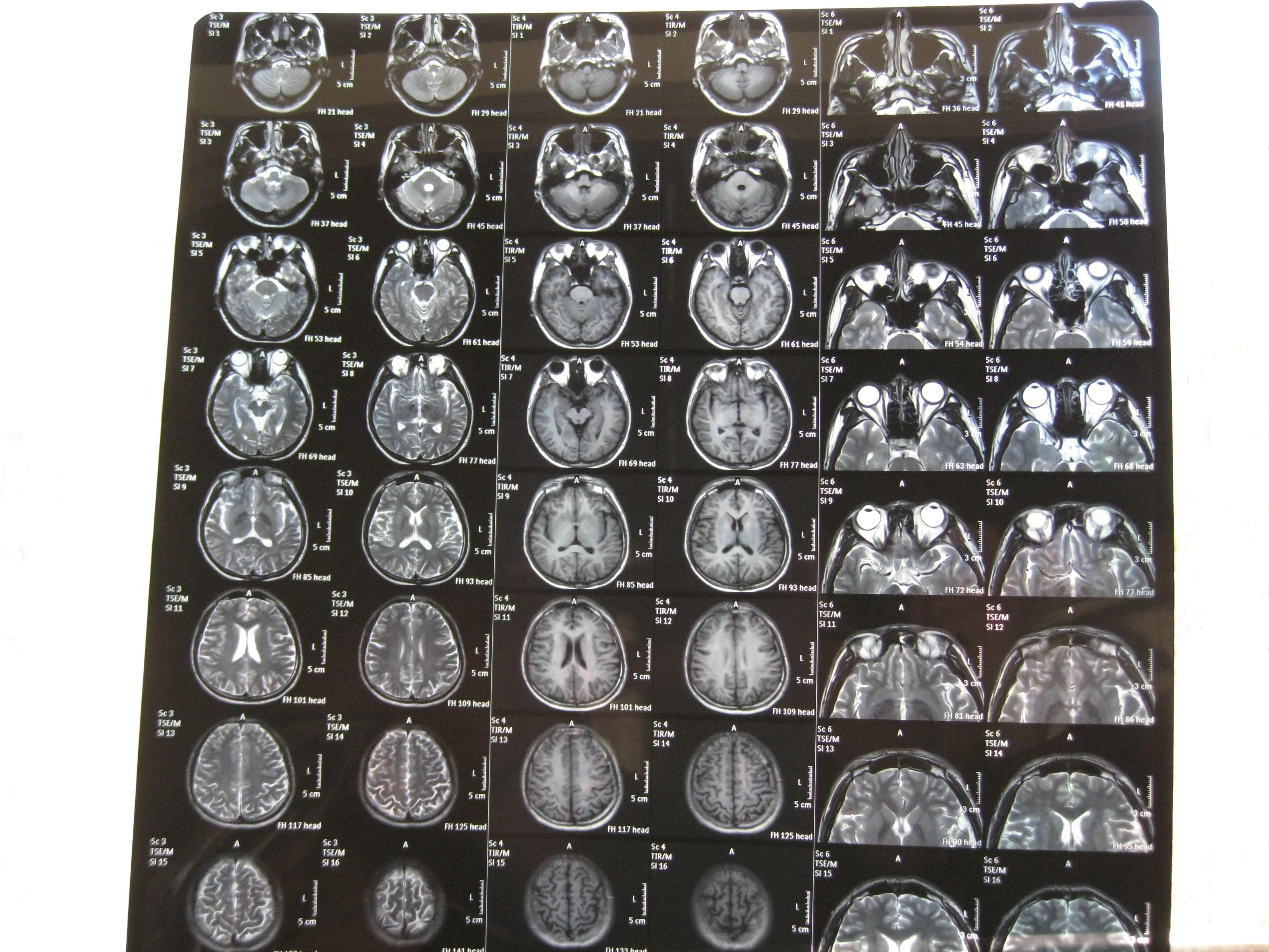 幫忙看一下頭顱mri