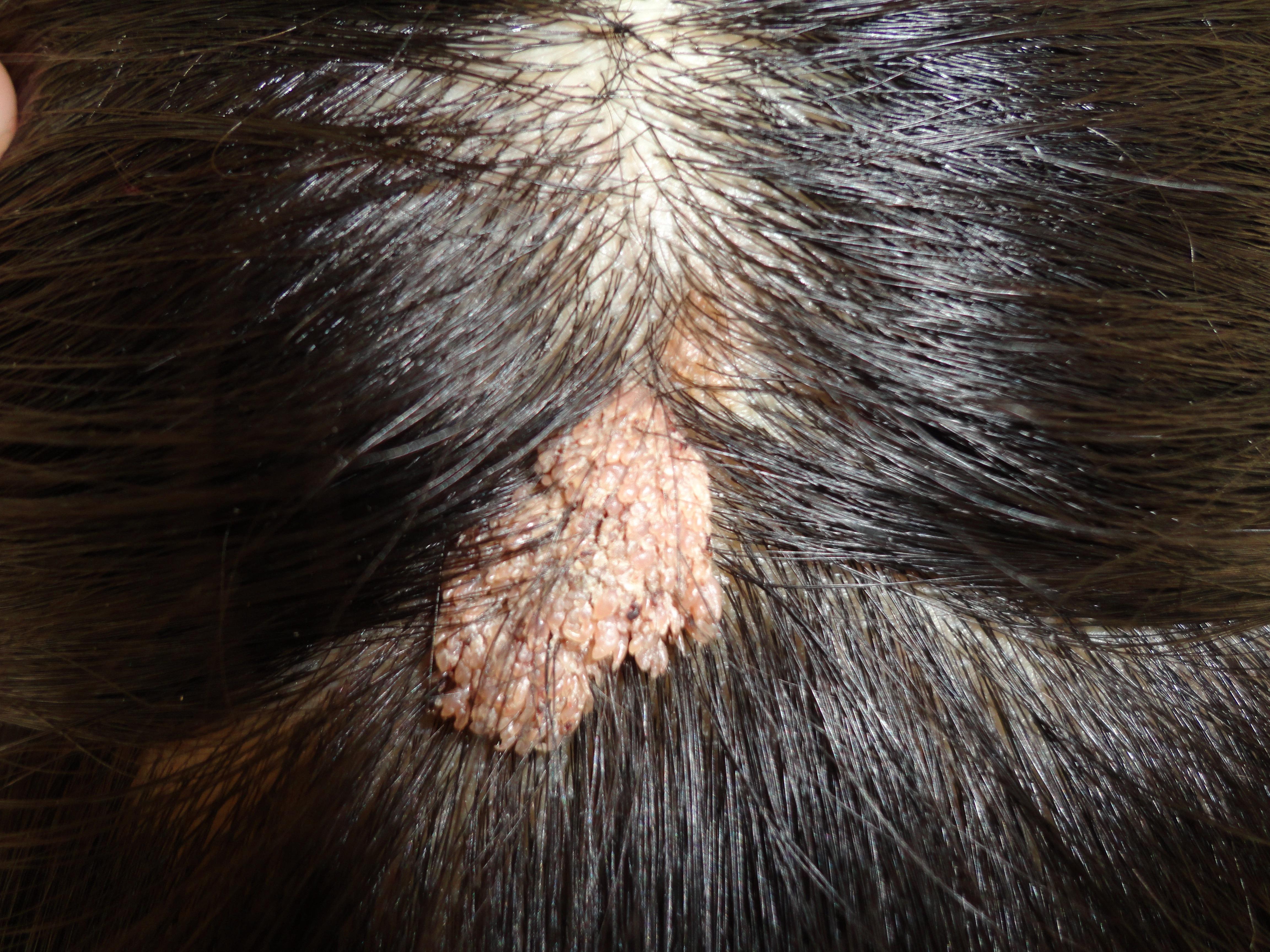 头皮软纤维瘤图片图片