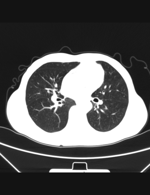 胸部ct平扫图片,金典=== - 医学影像学讨论版 - 爱爱医医学论坛