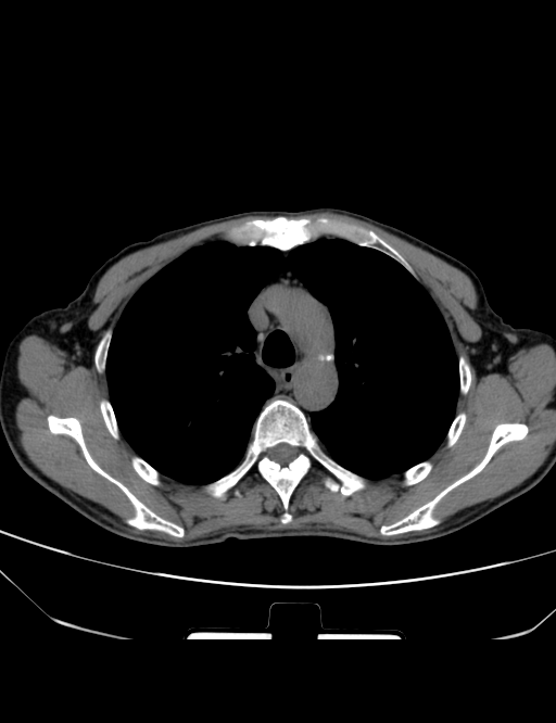 胸部ct平扫图片金典