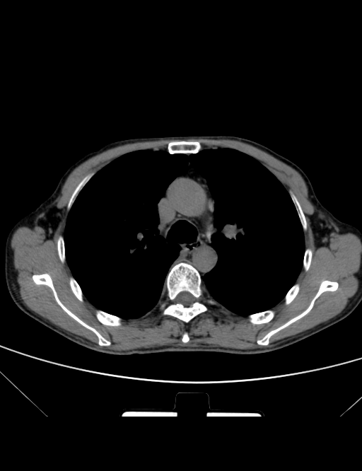 胸部ct平扫图片金典