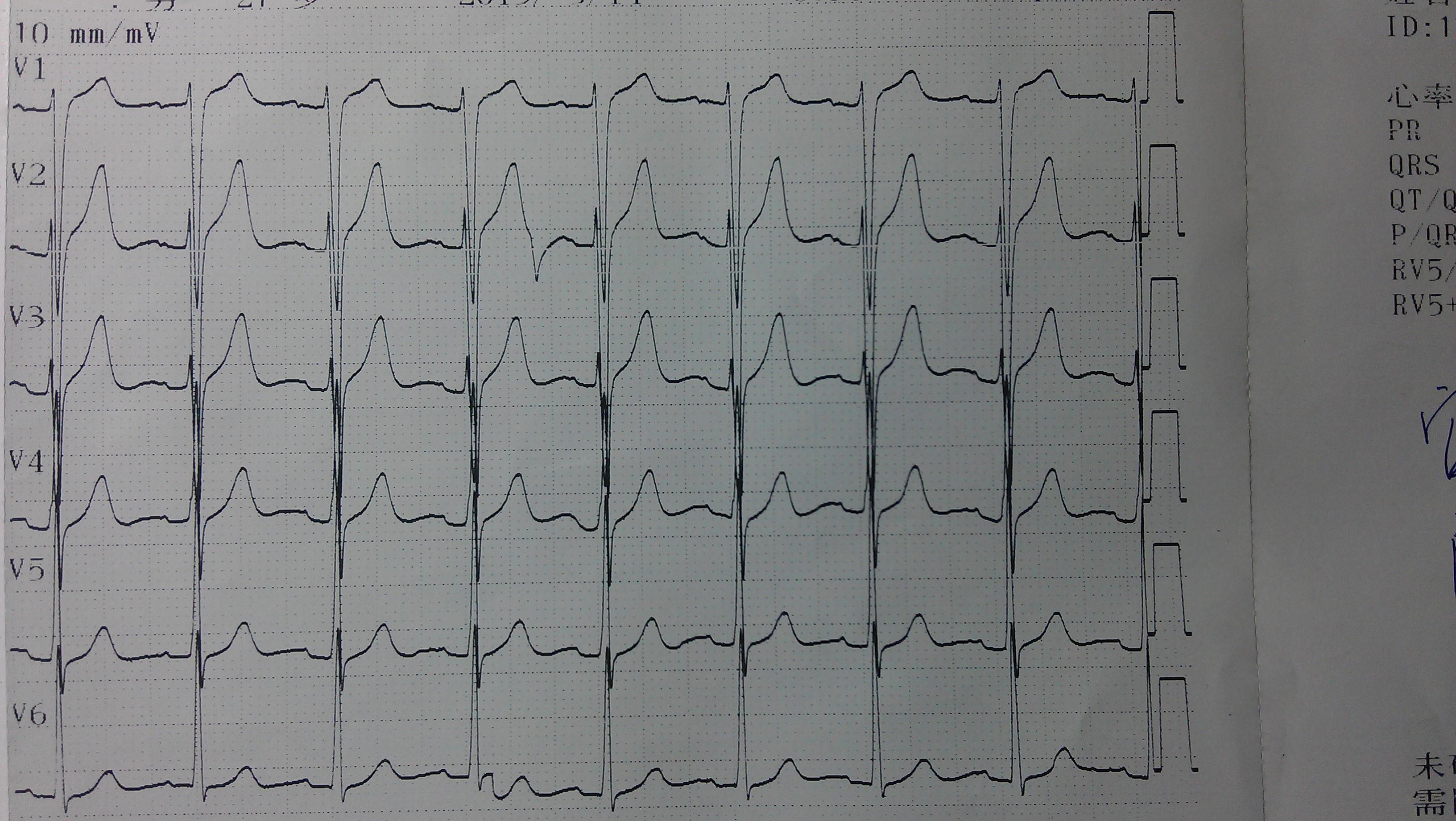 請各位老師斷定一下這份心電圖到底是正常的心電圖嗎