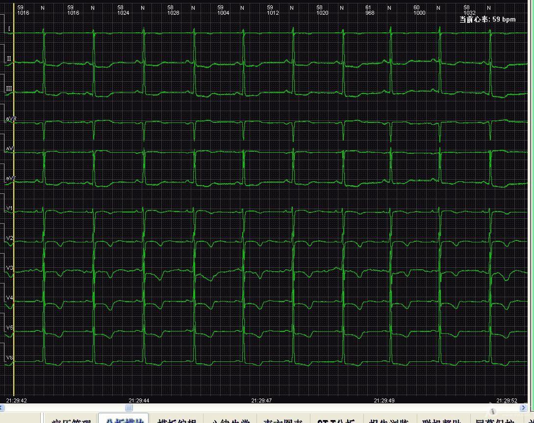 心电监护房颤波形图片图片