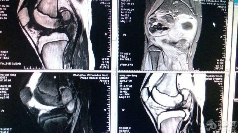 膝盖肿瘤图片