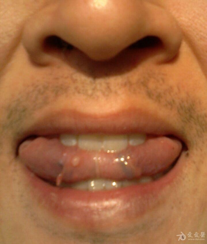 舌下腺肿瘤 恶性图片