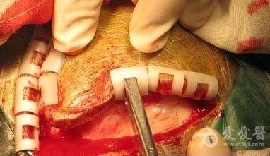 额窦炎微创手术过程图片