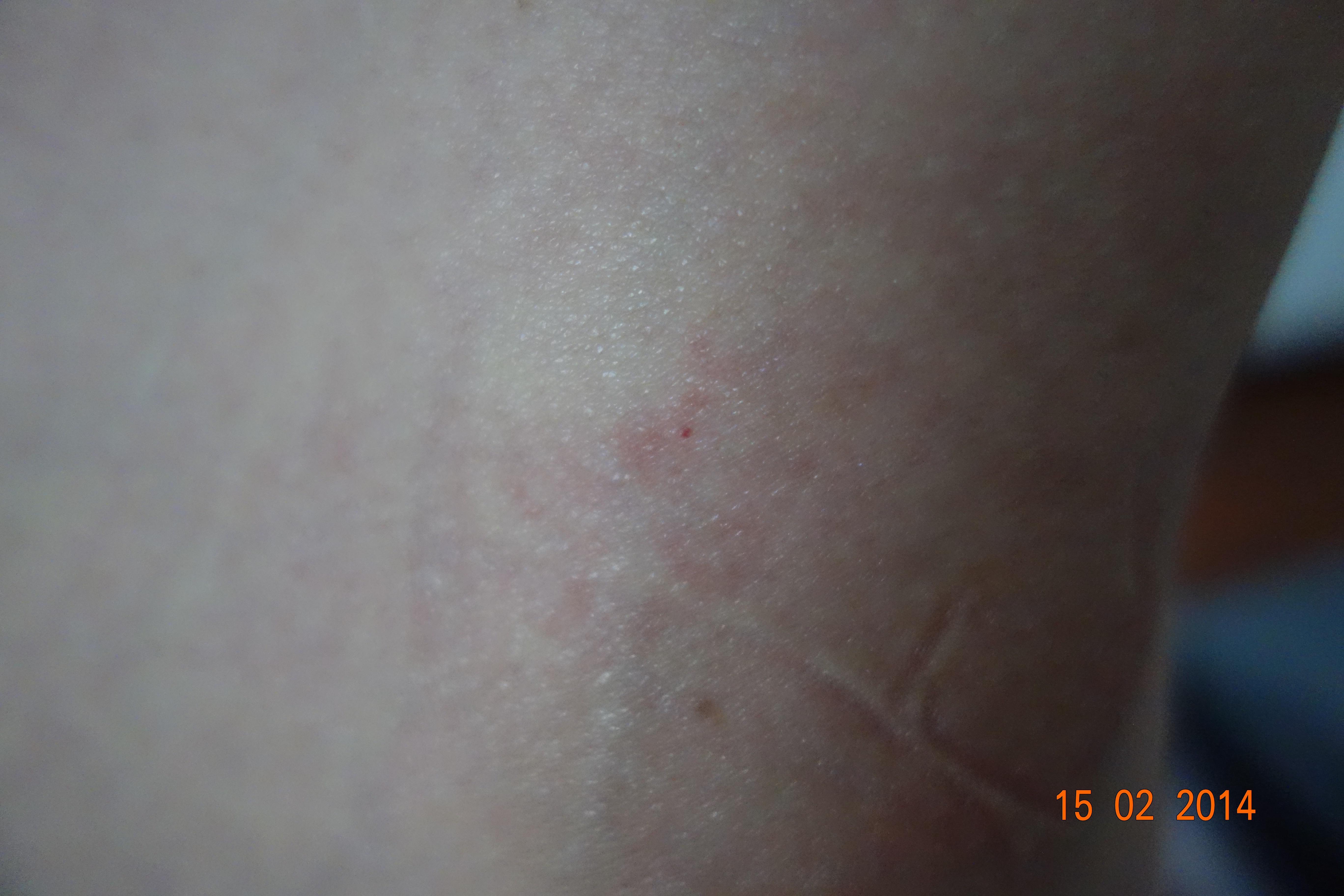 请老师们帮我看看这是疥疮治疗后过敏还是复发?求治疗方案