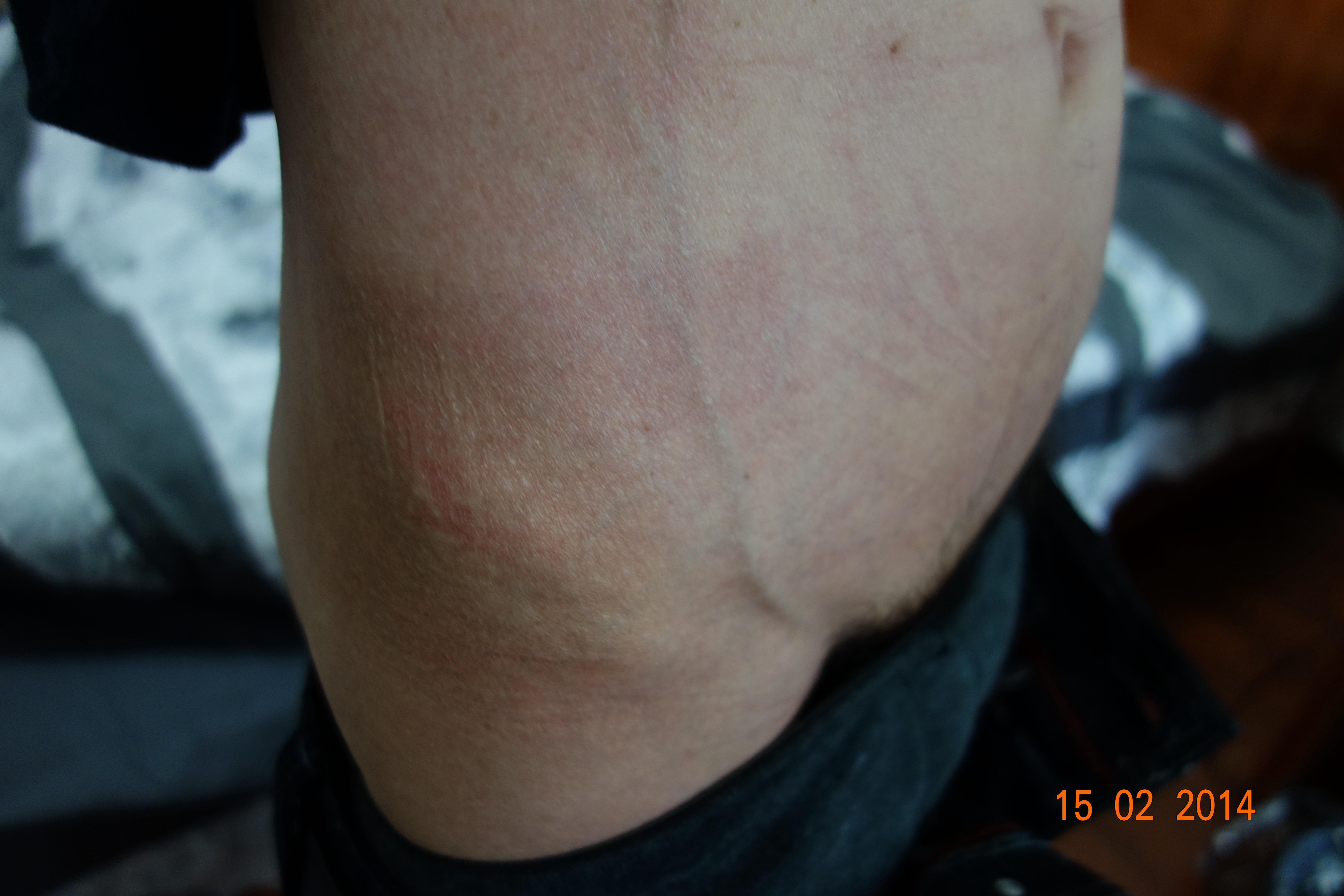 请老师们帮我看看这是疥疮治疗后过敏还是复发?求治疗方案