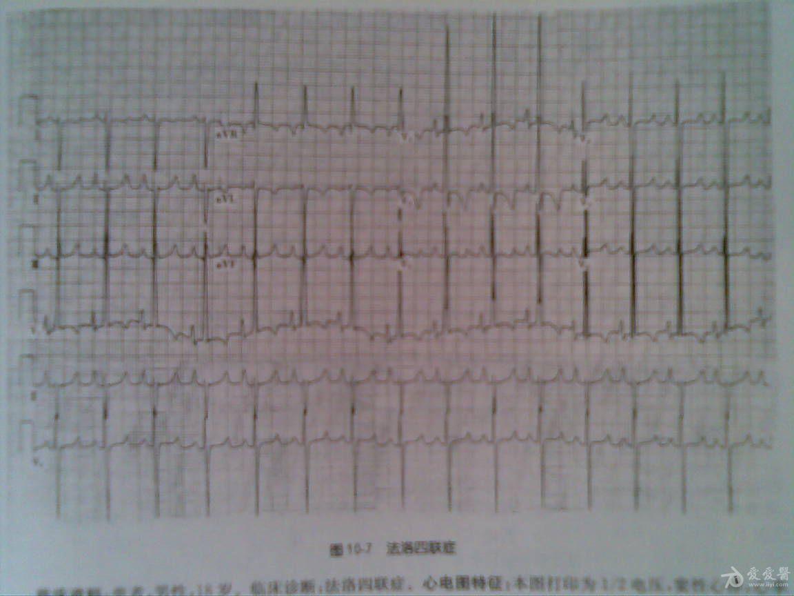 法洛四联症的心电图