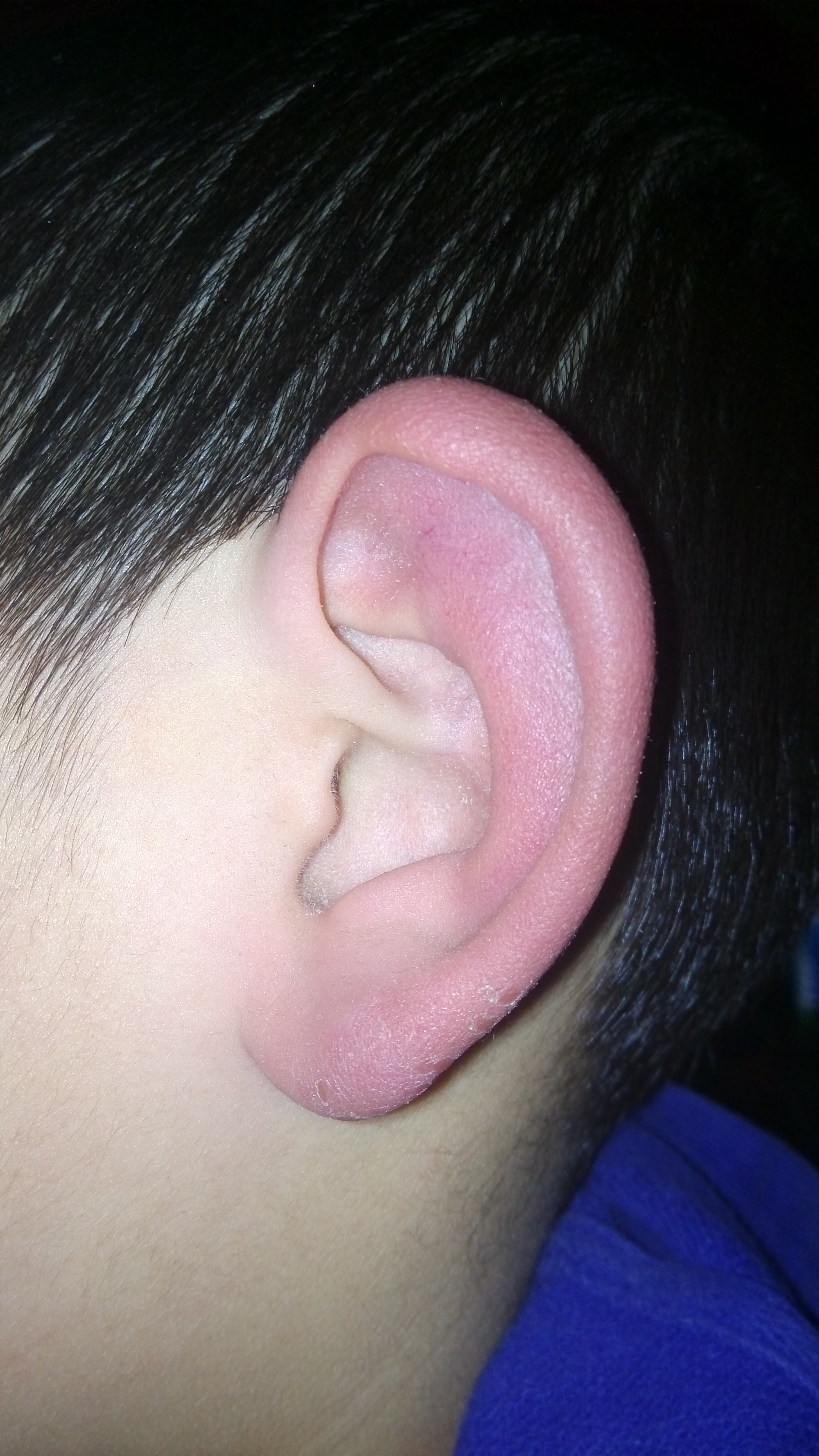 耳朵丹毒的症状图片图片