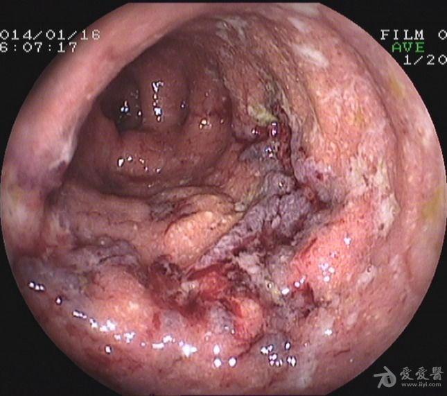 腹痛腹泻脓血便2月行肠镜检查请各位老师帮读片