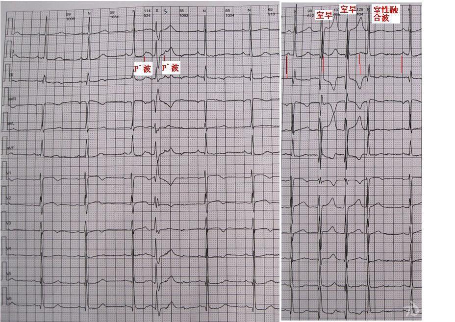房性早搏伴室内差传jpg