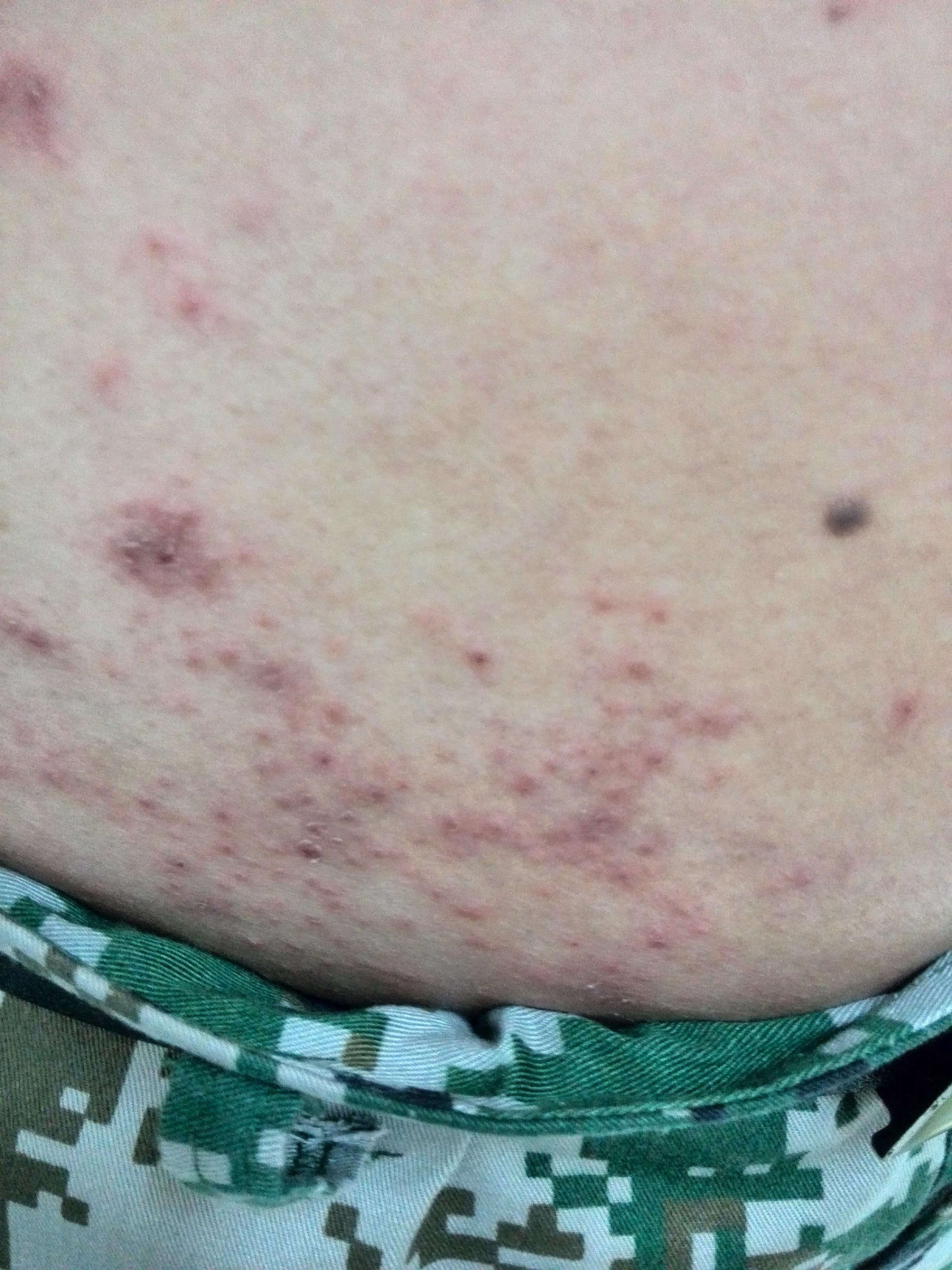 全身瘙痒性皮疹查因