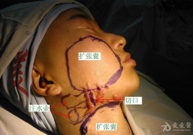 儿童扩张器手术图图片
