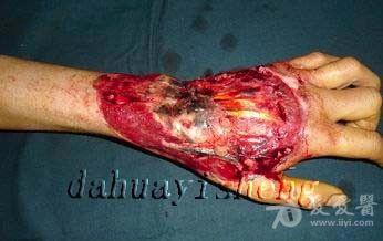 手背热压伤一例