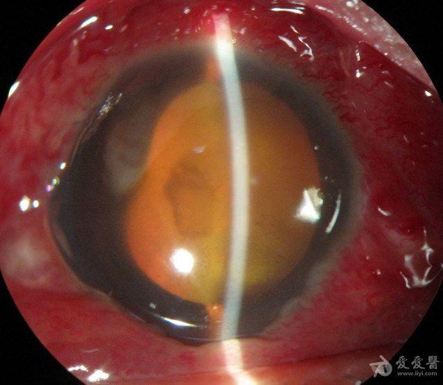 化脓性眼内炎合并眶蜂窝织炎如何治疗?