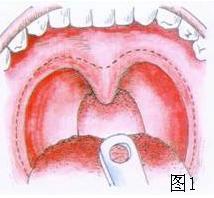 耳鼻咽喉头颈外科手术征集——腭咽成形术