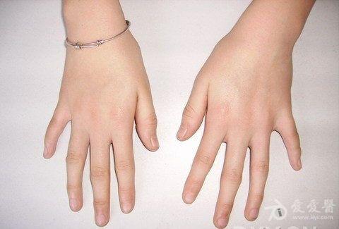 第五掌骨第四第五跖骨发育障碍一例