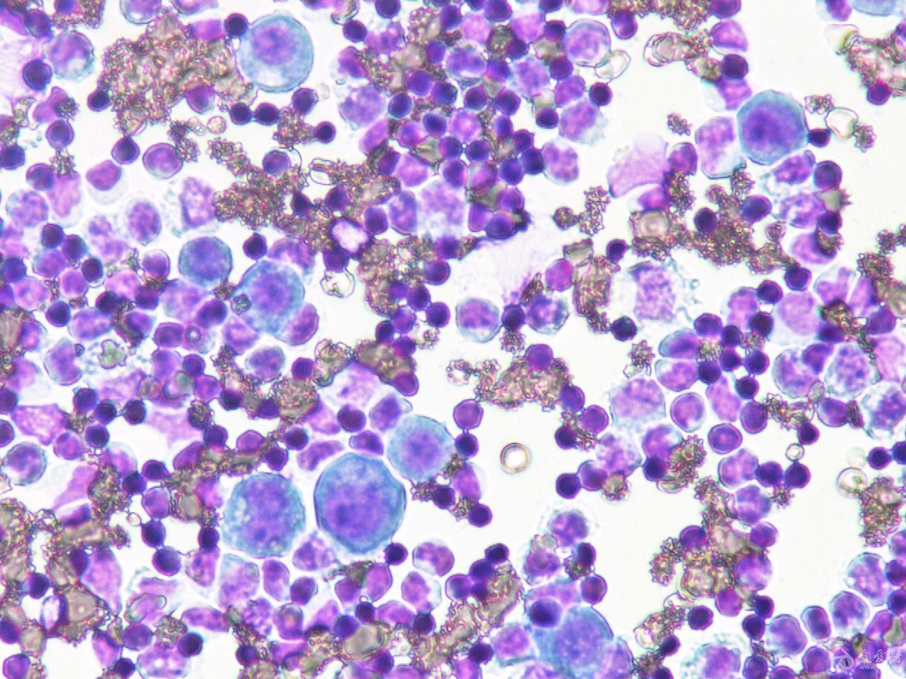 胸水细胞病理学:瑞士-吉姆萨染色