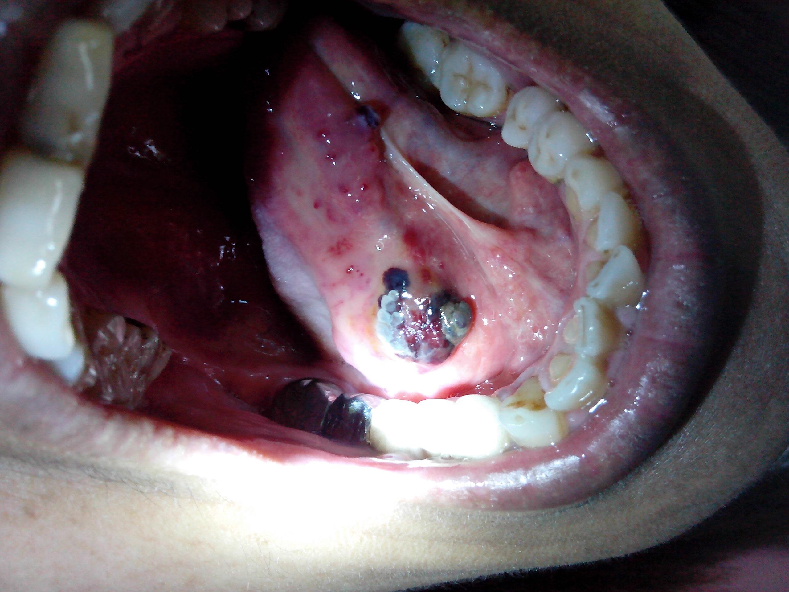 口腔内壁长了个血泡图片