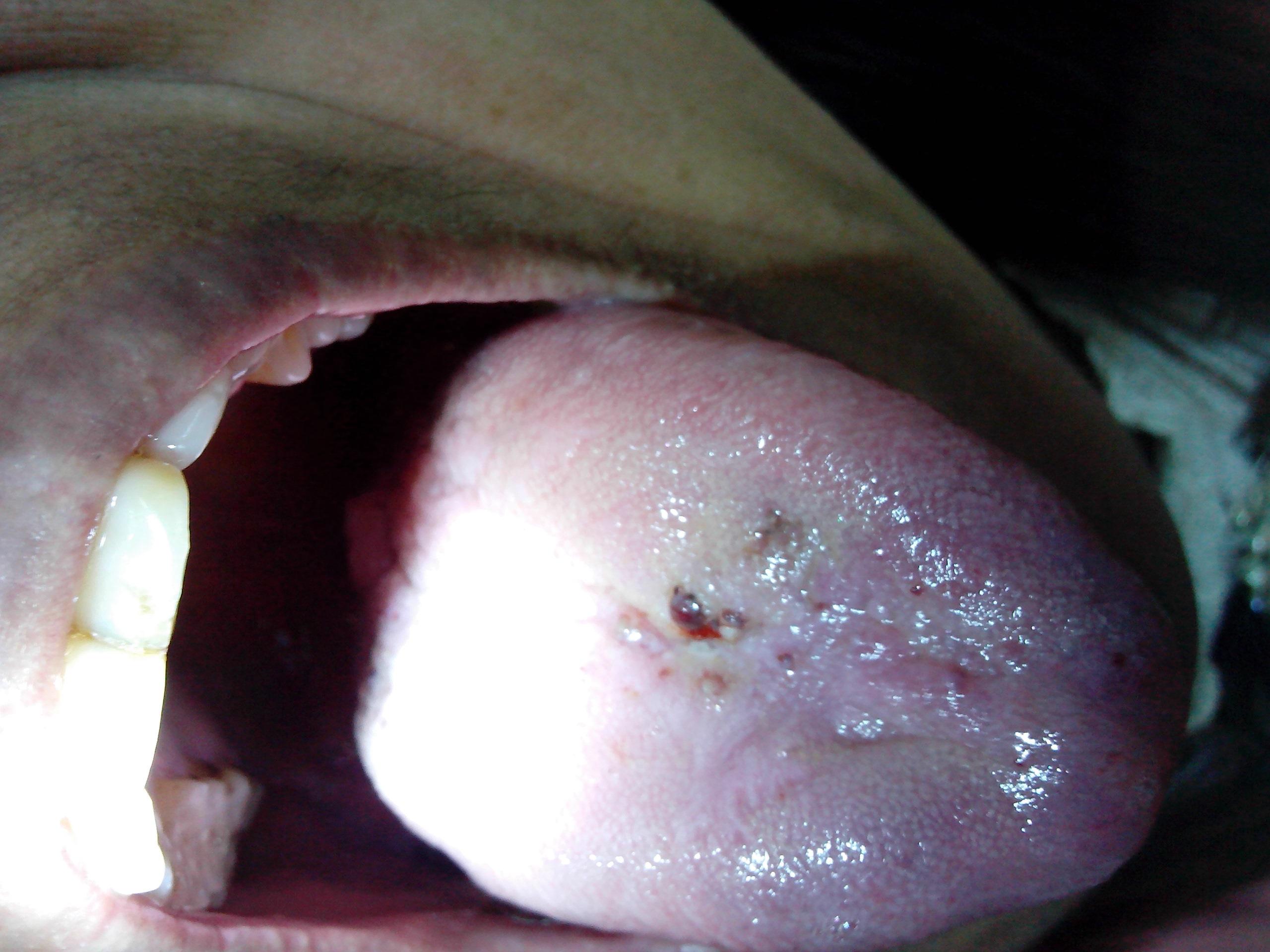口腔侧壁长血泡图图片